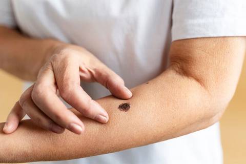 Estas son las señales de alerta del melanoma que pueden pasar inadvertidas: así puedes prevenir el cáncer de piel