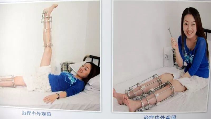El China esta operación ha sido muy popular entre las mujeres. GETTY IMAGES