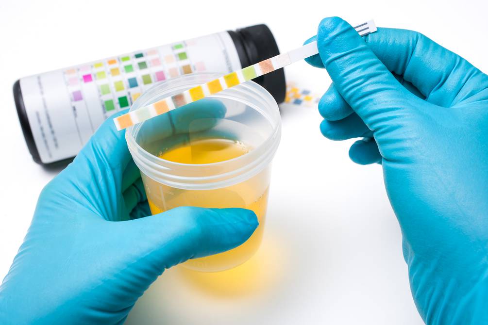 Urine colors: what they mean and when it’s time to see a doctor  Health  magazine