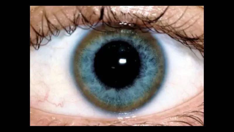 El aro de cobre en los ojos es uno de los síntomas de Wilson. CRMR WILSON PARIS