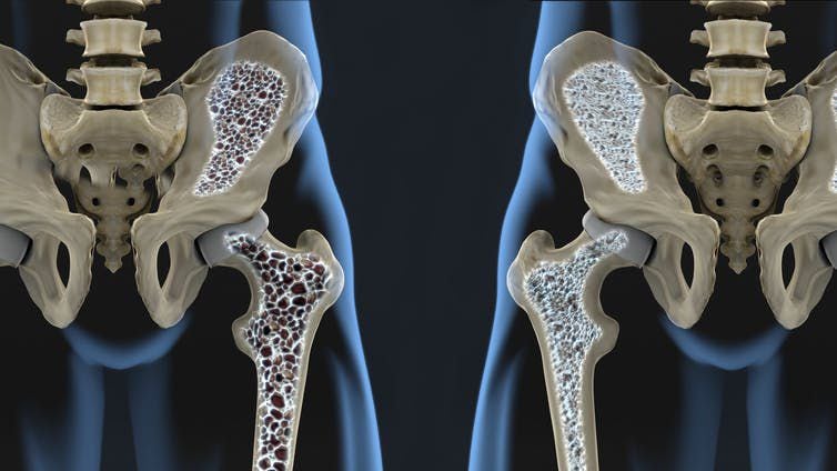Preguntas y respuestas sobre la osteoporosis