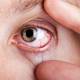 Las causas por las que el ojo se pone rojo con sangre: ¿Cuándo debes acudir a un médico?