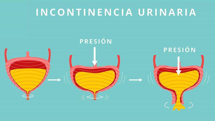 Cómo tratar la incontinencia urinaria nocturna en ancianos - Teleasistencia