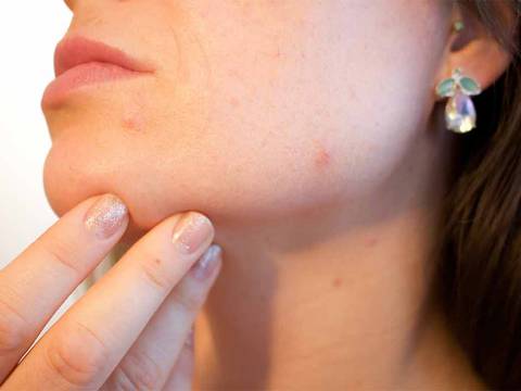 Dos suplementos que te pueden ayudar a reducir el acné y lucir una piel perfecta: Estas son las dosis diarias recomendadas