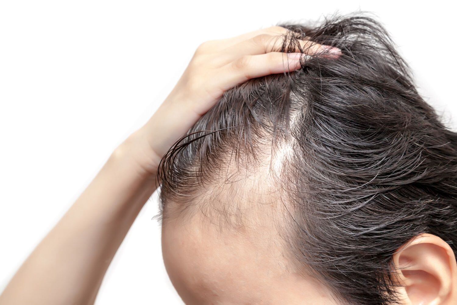 La pérdida de cabello suele ser más común en los hombres