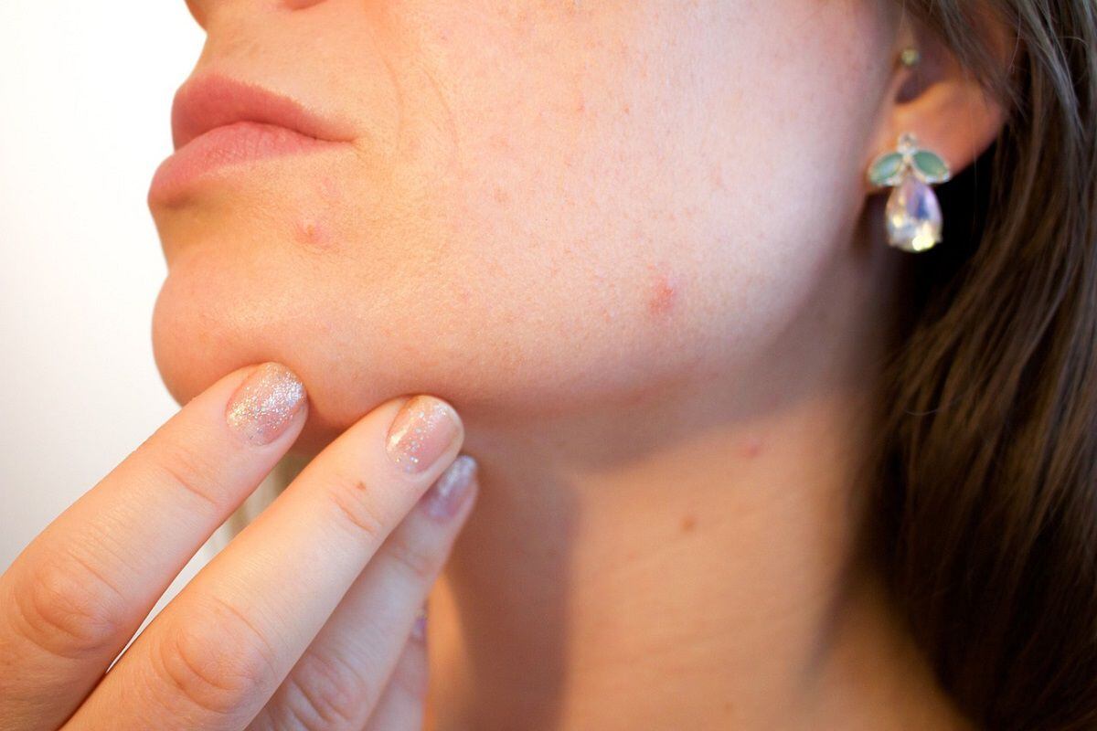  El acné es una afección inflamatoria que puede mejorar con el consumo de omega 3 y zinc. Foto: Pexels/Kjerstin_Michaela