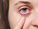 ¿Qué hacer ante un rasguño en el ojo? Primeros auxilios y todo lo que debes saber sobre esta lesión ocular