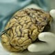Inteligencia artificial puede predecir la tasa de supervivencia de pacientes de cáncer de cerebro