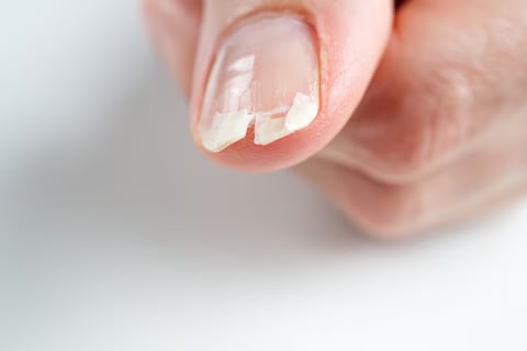 Estos son los síntomas de la falta de selenio que se reflejan en uñas y cabello