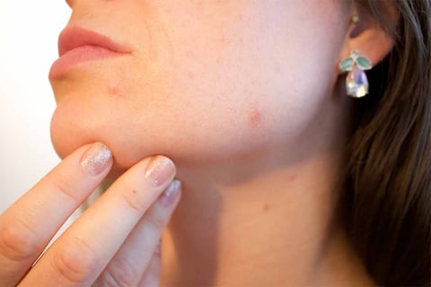 Dos suplementos que te pueden ayudar a reducir el acné y lucir una piel perfecta: Estas son las dosis diarias recomendadas