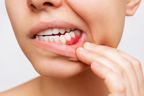 Gingivitis: la placa bacteriana que inflama las encías se puede transmitir con un beso