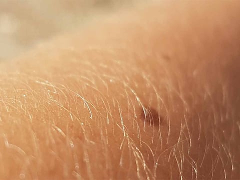 Dermatólogo advierte sobre extraño síntoma en la piel que podría ser una señal temprana de cáncer